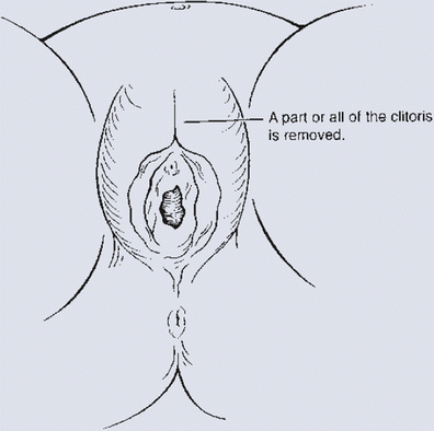 Clitorectomy After Clitorectomy After