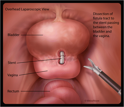 Laparoscopic extravesical vesicovaginal fistula repair: our  