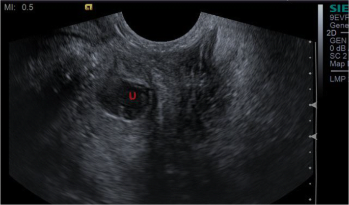 urethral diverticulum ultrasound