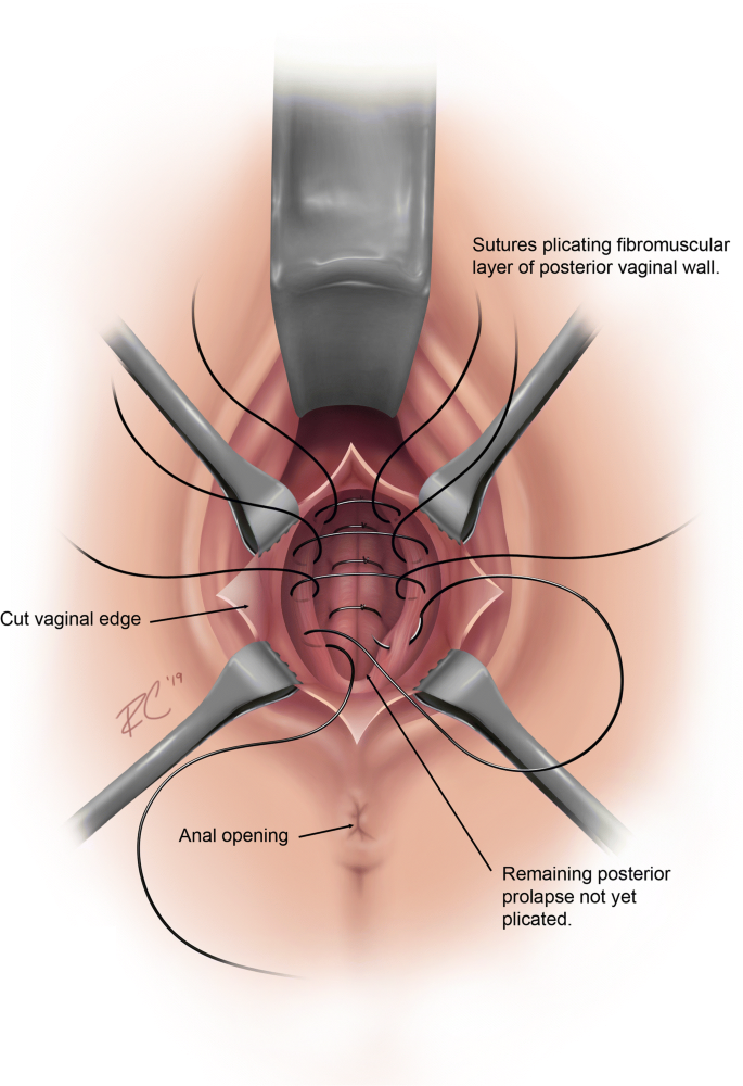 Joint report on terminology for surgical procedures to treat pelvic organ  prolapse | SpringerLink