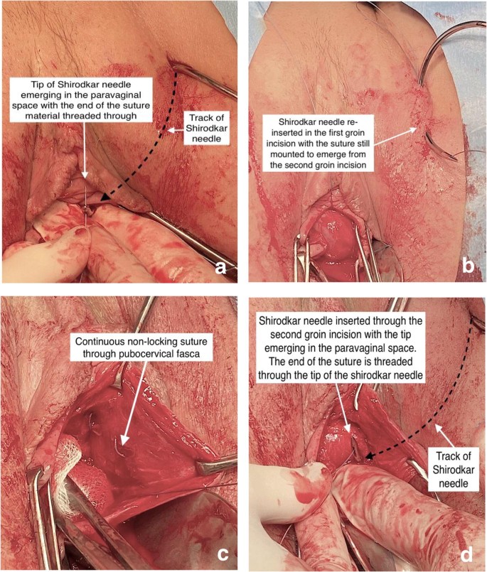 Anterior vaginal prolapse (cystocele) - Diagnosis and treatment