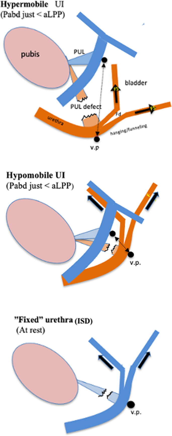The Urethral Hanging Theory: A Unified Biomechanical Model for the ...