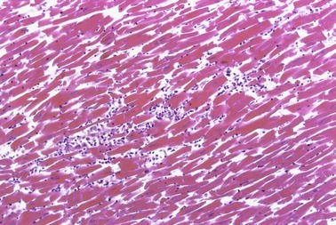 Myokarditis Springerlink