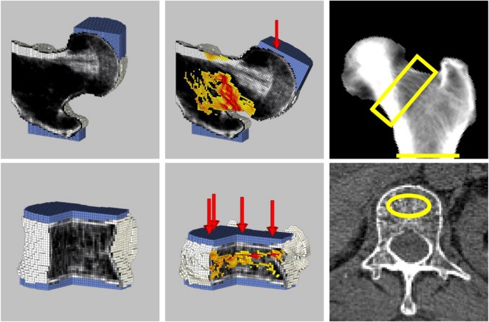 Biomechanical Computed Tomography analysis (BCT) for clinical assessment of  osteoporosis | SpringerLink