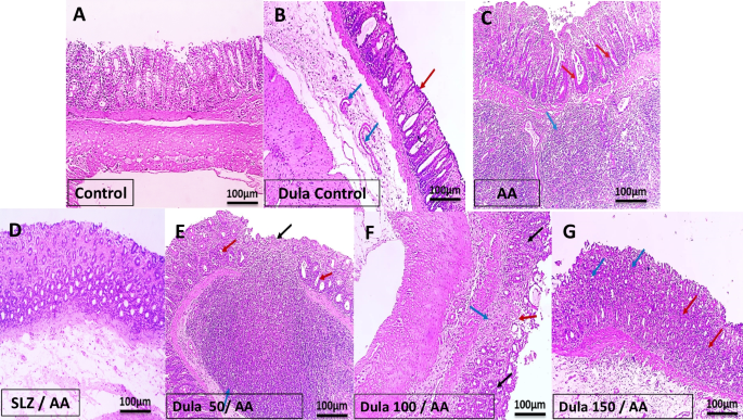 ulcerative colitis and glp 1 Protective effect of Dulaglutide, a GLP1 agonist, on acetic acid-induced ulcerative  colitis in rats: involvement of GLP-1, TFF-3, and TGF-β/PI3K/NF-κB  signaling pathway | Naunyn-Schmiedeberg's Archives of Pharmacology
