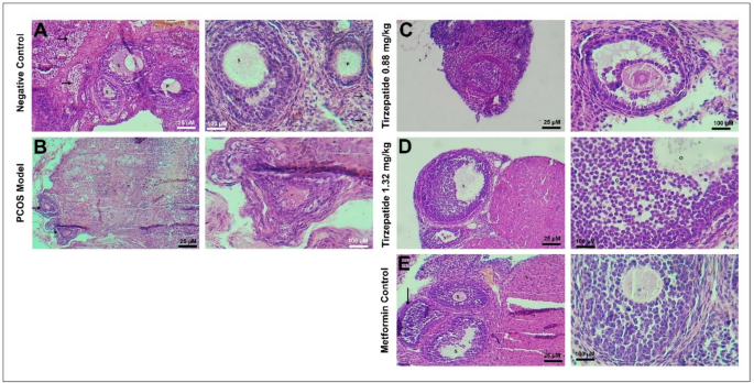 how does tirzepatide help pcos Possible protective effects of tirzepatide on polycystic ovary syndrome in  female rat model induced by testosterone propionate in comparison to  metformin | Naunyn-Schmiedeberg's Archives of Pharmacology