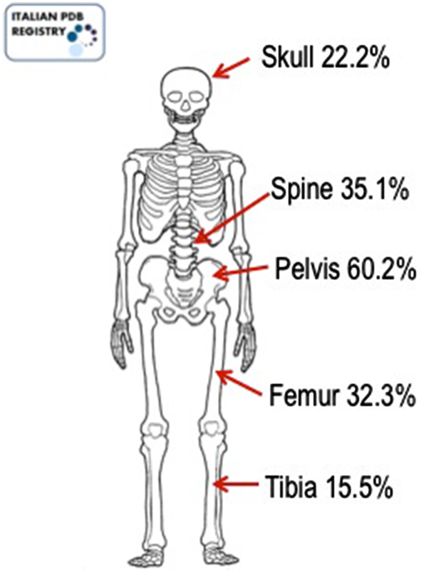 Paget's Disease of Bone | SpringerLink