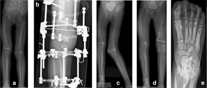 erős phylloidosis és teniosis