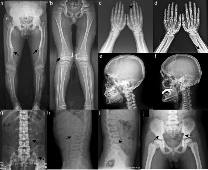 Clinical Characteristics and Bone Features of Autosomal Recessive  Hypophosphatemic Rickets Type 1 in Three Chinese Families: Report of Five  Chinese Cases and Review of the Literature | SpringerLink