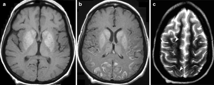 Ct And Mr In Non Neonatal Hypoxic Ischemic Encephalopathy Radiological Findings With Pathophysiological Correlations Springerlink