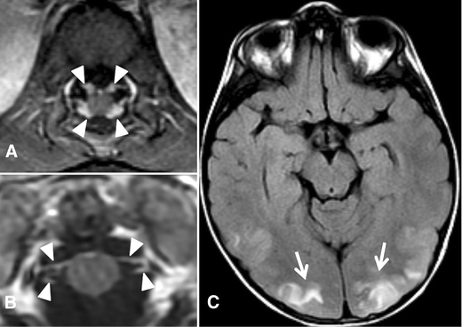 Guillain Barre Syndrome Related Posterior Reversible Encephalopathy Syndrome Springerlink