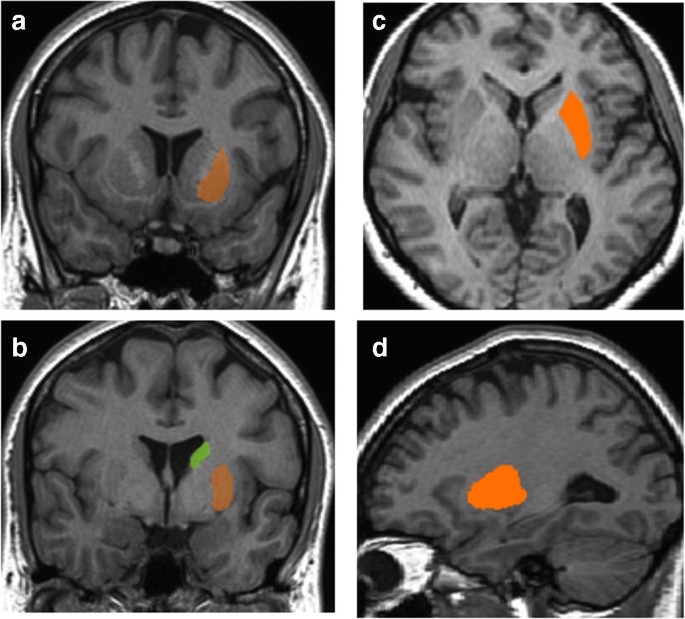 Structural neuroimaging findings in migraine patients with ...