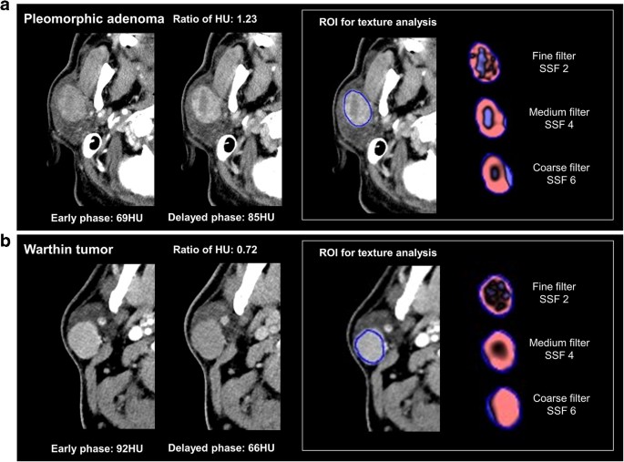 pleomorphic adenoma mri)