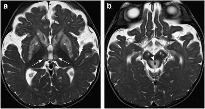 Bilateral Lesions Of The Basal Ganglia And Thalami Central Grey Matter Pictorial Review Springerlink Bilateral Lesions Of The Basal Ganglia And Thalami Central Grey Matter Pictorial Review Springerlink