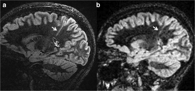 Clinical 7 T Mri For Neuroradiology Strengths Weaknesses And Ongoing Challenges Springerlink
