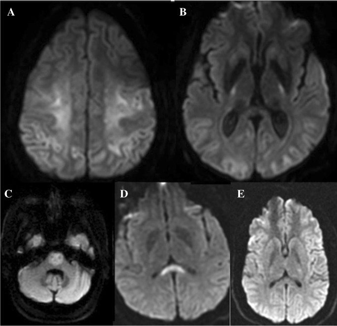 Clinical applications of diffusion-weighted sequence in brain imaging:  beyond stroke | SpringerLink