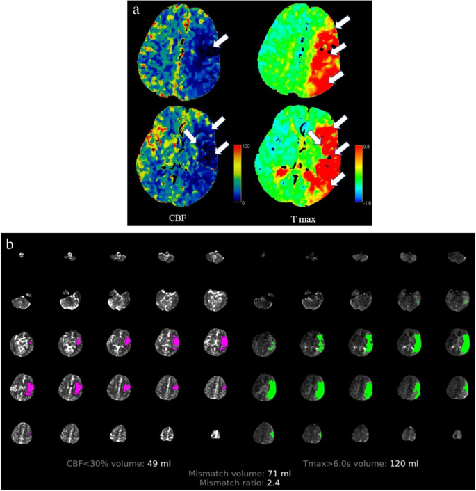 Diagnostic accuracy of using Alberta Stroke Program Early Computed  Tomography Score on CT perfusion map to predict a target mismatch in  patients with acute ischemic stroke | SpringerLink