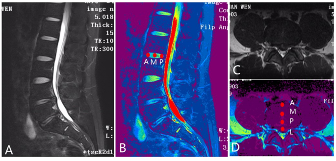 Regional T2 value differences assess lumbar disc degeneration: a 3.0-T ...