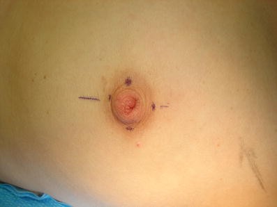 The trampoline repair for inverted nipples | SpringerLink The trampoline repair for inverted nipples | SpringerLink