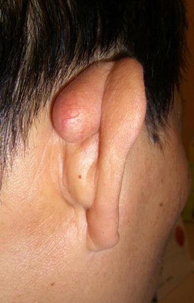 hello doctor my child got this lump behind ear is this normal its not  paining  FirstCry Parenting