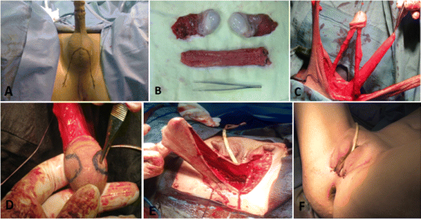 Post Op Vaginoplasty Post Op Vaginoplasty