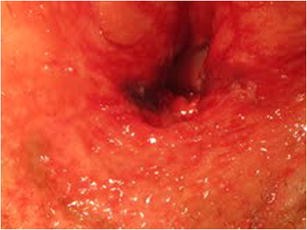 How to treat a vaginal burn due to acetic acid? | SpringerLink How to treat a vaginal burn due to acetic acid? | SpringerLink