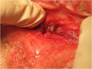 How To Treat A Vaginal Burn Due To Acetic Acid Springerlink