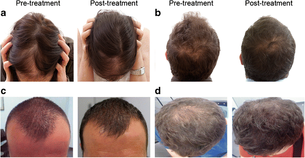 Management of androgenetic alopecia: a comparative clinical study between  plasma rich in growth factors and topical minoxidil | SpringerLink
