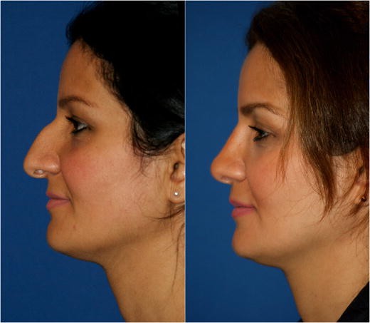 Prominent nose, its modalities and their treatment | European Journal of  Plastic Surgery