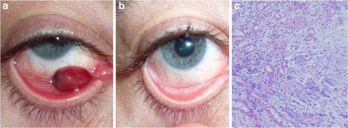 transconjunctival blepharoplasty