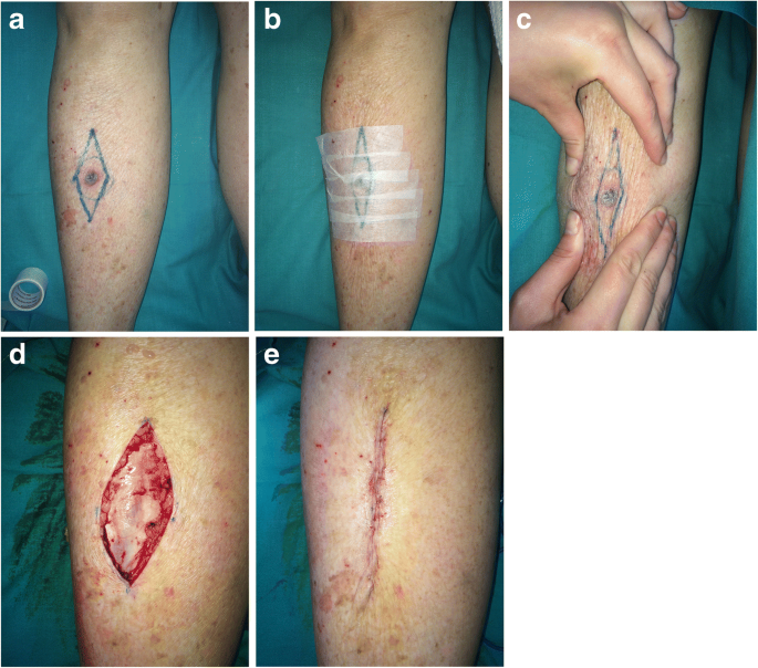acute tissue expansion by pretaping to achieve elliptical excision and closure for skin tumours and soft tissue tumours springerlink acute tissue expansion by pretaping to achieve elliptical excision and closure for skin tumours and soft tissue tumours springerlink