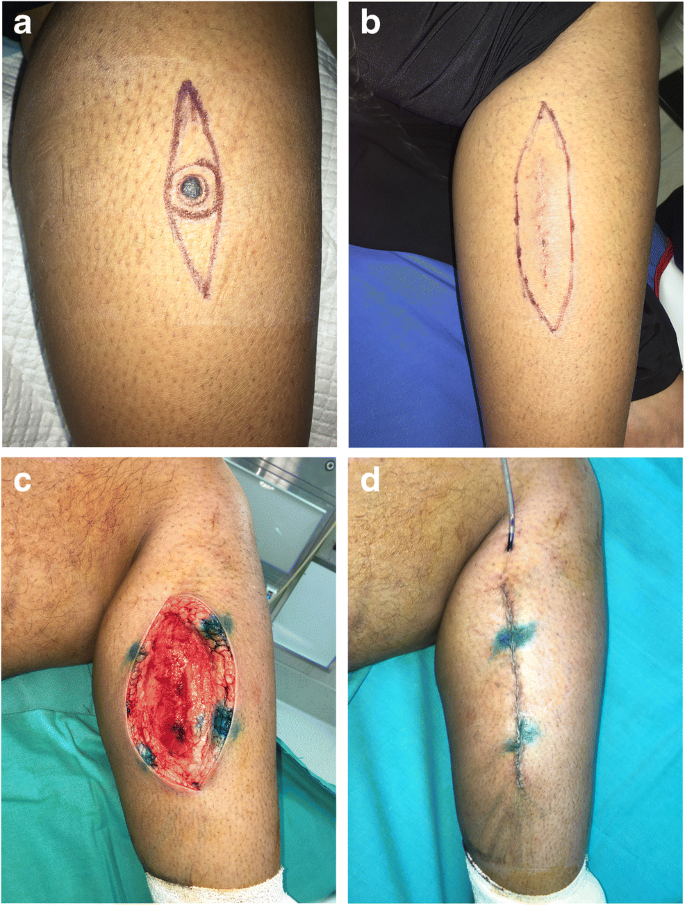 acute tissue expansion by pretaping to achieve elliptical excision and closure for skin tumours and soft tissue tumours springerlink acute tissue expansion by pretaping to achieve elliptical excision and closure for skin tumours and soft tissue tumours springerlink