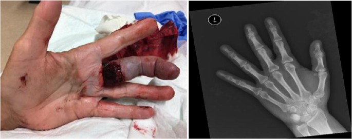 Treating a subtotal degloving ring avulsion with leeches: an unusual case report with review of the literature | SpringerLink Treating a subtotal degloving ring avulsion with leeches: an unusual case report with review of the literature | SpringerLink