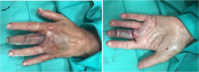 Treating a subtotal degloving ring avulsion with leeches: an unusual case  report with review of the literature | SpringerLink