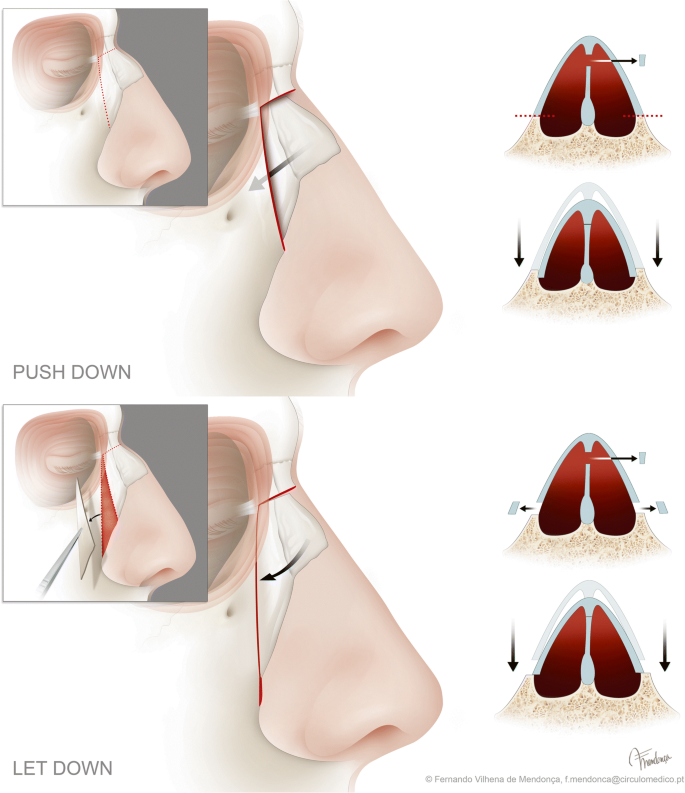Rhinoplasty Seattle - Nose Surgery Bellevue - Nose Job Seattle