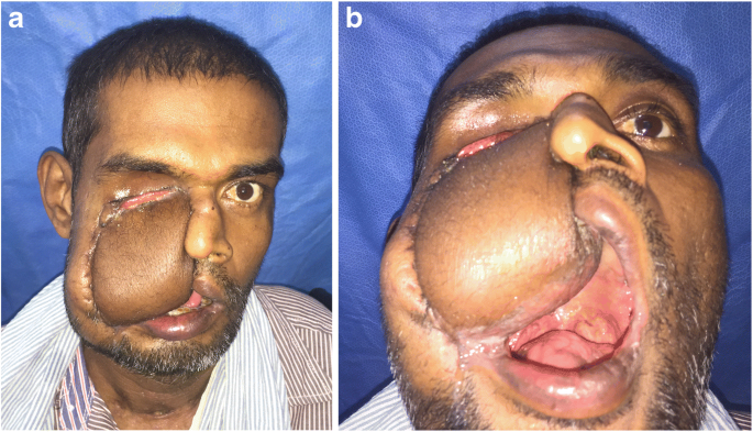 Cranio Facial Mucormycosis The Plastic Surgeon S Perspective Springerlink