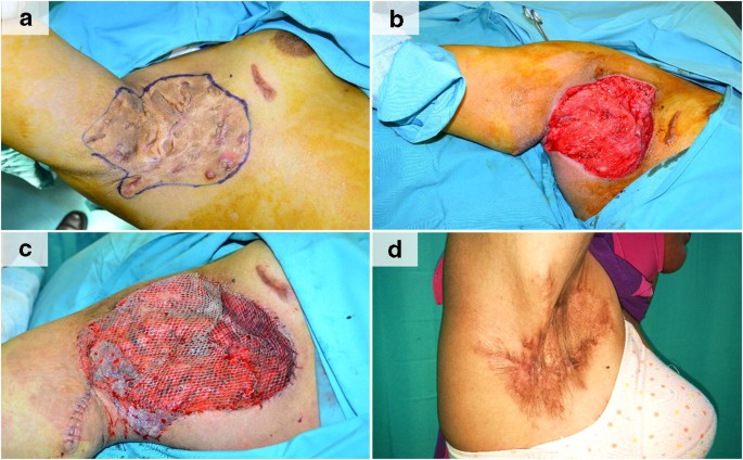 A Review Of The Reconstructive Methods In The Management Of Axillary Hidradenitis  Suppurativa | Springerlink