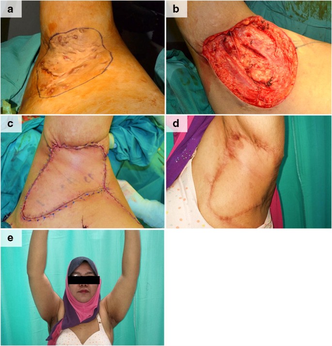 A Review Of The Reconstructive Methods In The Management Of Axillary Hidradenitis  Suppurativa | Springerlink
