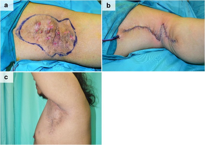 A Review Of The Reconstructive Methods In The Management Of Axillary Hidradenitis Suppurativa Springerlink A Review Of The Reconstructive Methods In The Management Of Axillary Hidradenitis Suppurativa Springerlink