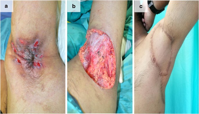 A Review Of The Reconstructive Methods In The Management Of Axillary Hidradenitis  Suppurativa | Springerlink
