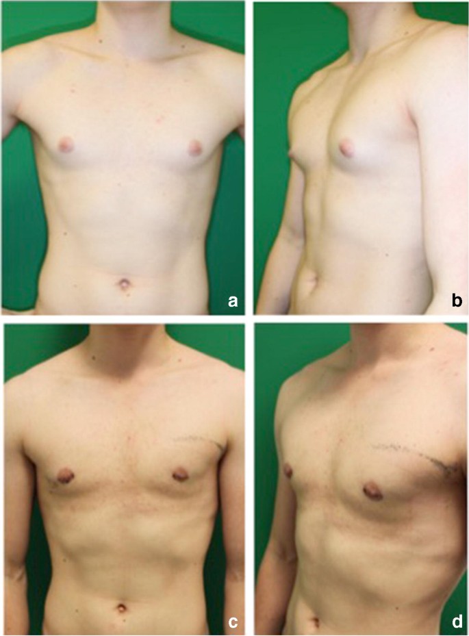 Surgical treatment of gynaecomastia: a standard of care in plastic