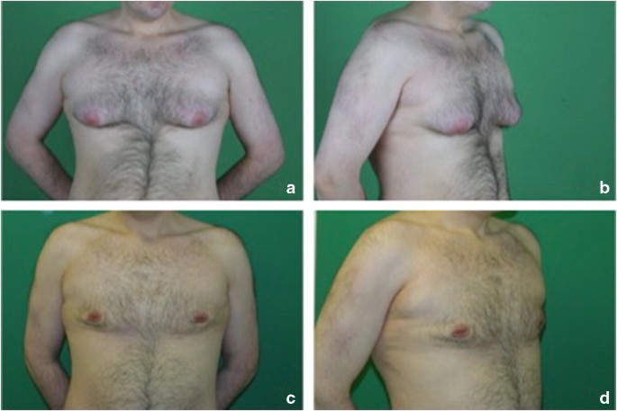 Prostatitis és gynecomastia