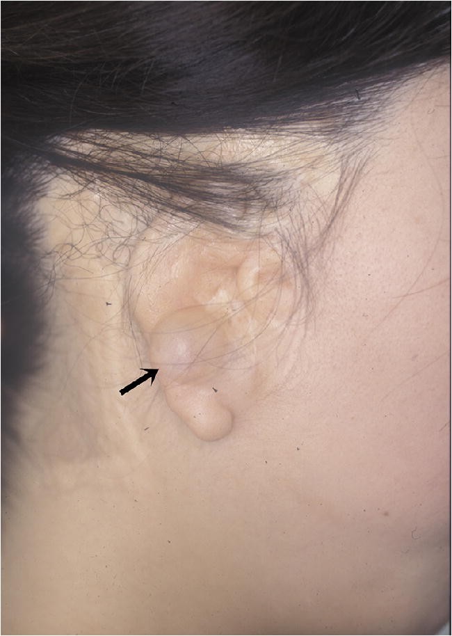 How To Get Rid Of Lump In Earlobe  Dr Piercing Aftercare