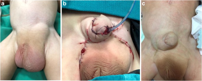 Surgical reconstruction of abnormally located penis in urorectal septum  malformation sequence: report of a case | SpringerLink