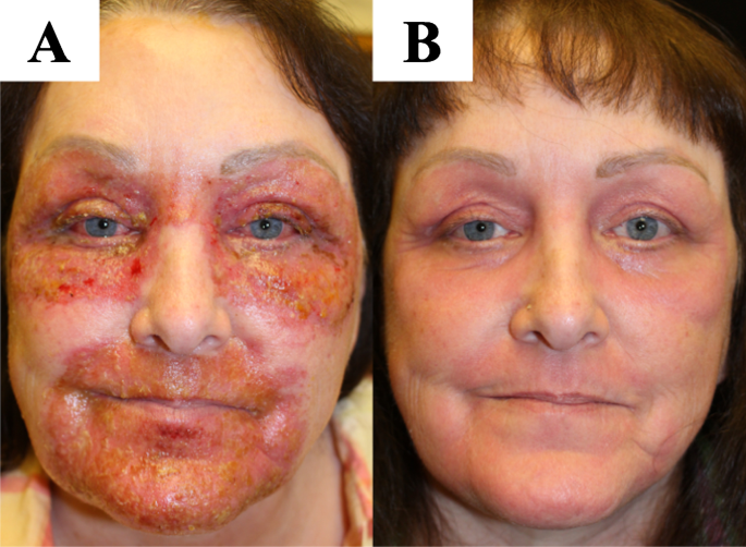 Safety of laser skin resurfacing in immunocompromised and diabetic patients  | SpringerLink