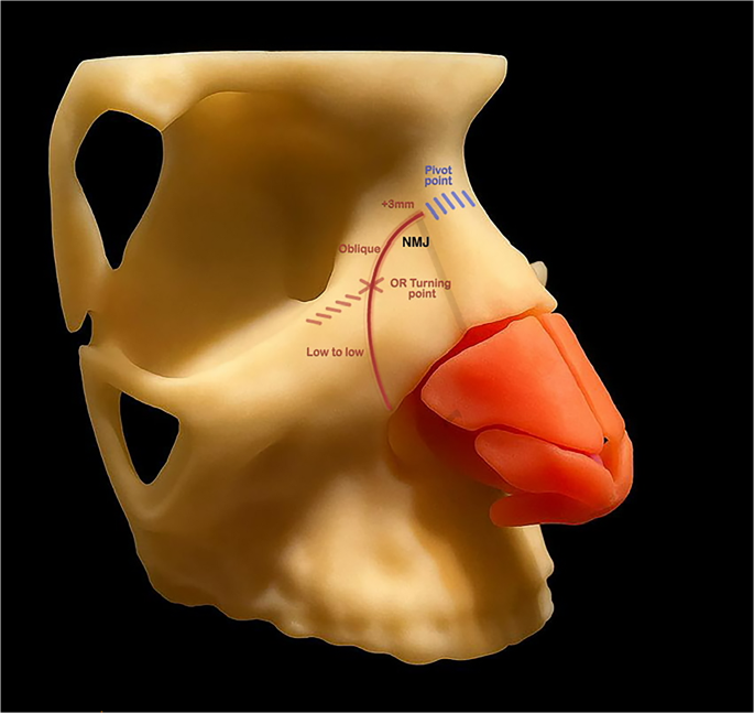 Hinge maneuver and pivot point: the nasomaxillary articulation as a ...