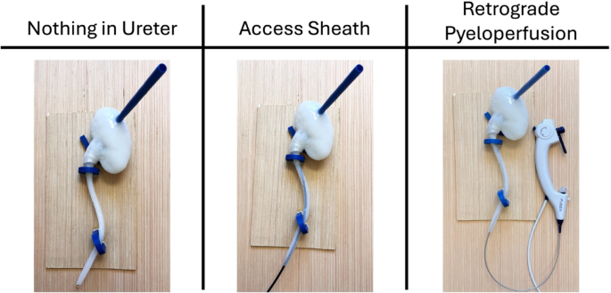 Retrograde pyeloperfusion: a novel technique to prevent stone fragment ...