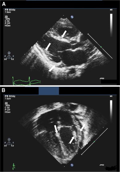 Echocardiographic Detection of Early Myocardial Calcification in Acute  Neonatal Myocarditis Due to Coxsackie Virus Type B | SpringerLink