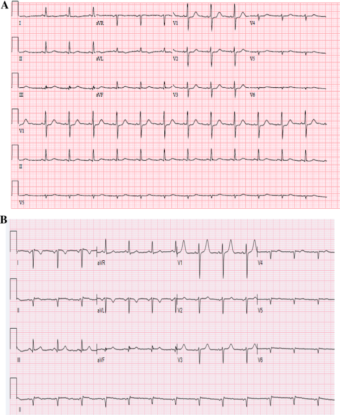 An Unusual Electrocardiogram Springerlink An Unusual Electrocardiogram Springerlink