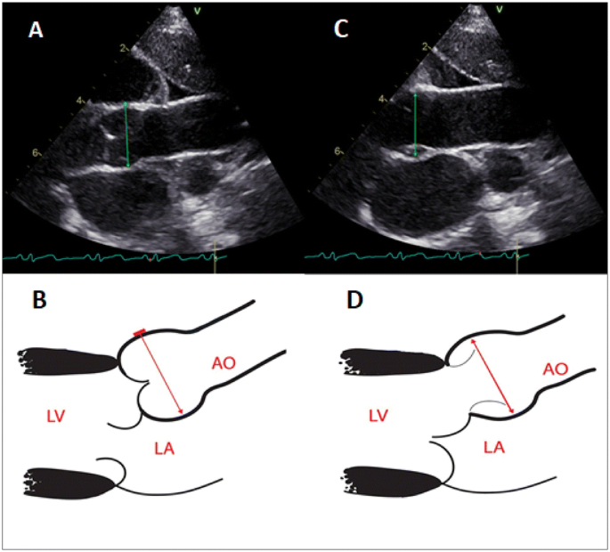 New Screening Tool for Aortic Root Dilation in Children with 
